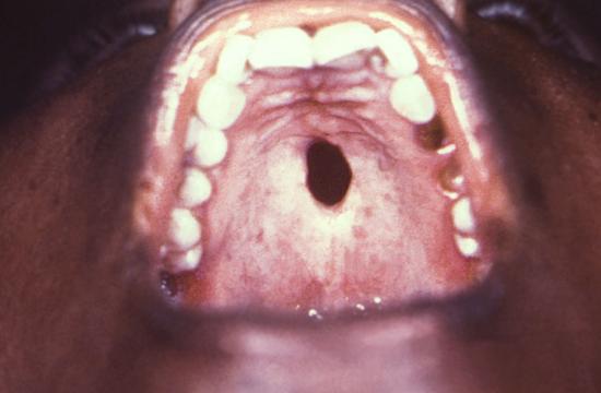 Syphilis affecting roof of mouth. Image credit: CDC/ Robert E. Sumpter, 1967.
