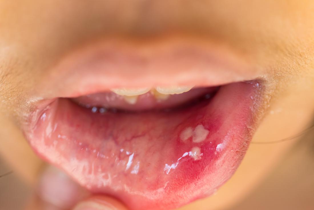 HPV in mouth.