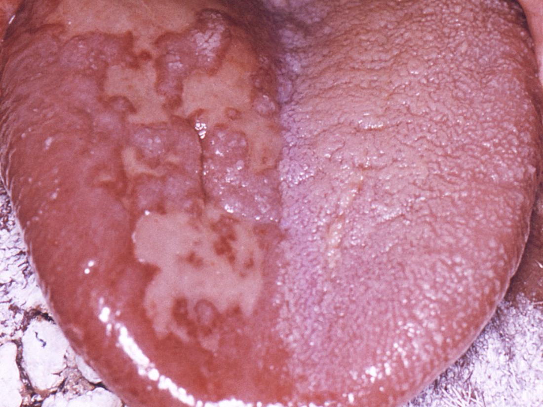 Herpes affecting tongue. Image credit: CDC/ Robert E. Sumpter, 1967.