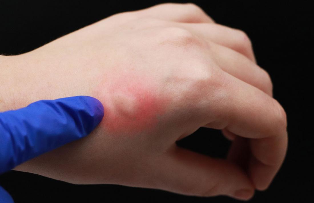 Skeeter syndrome causing allergic reaction to a mosquito bite on hand.