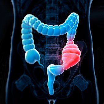 An illustration of a constipated colon which is associated with irritable bowel syndrome (IBS).