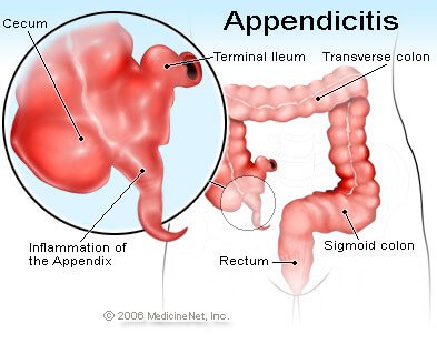 Appendicitis Illustration - Inflammation of the Appendix