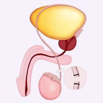 Vasectomies and tubal ligation offer a more permanent birth control solution.