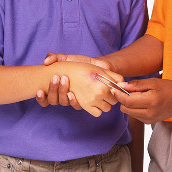 A person uses tweezers to pull a foreign object from another person’s hand.