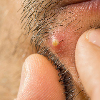 A close-up of a boil on a man’s face.