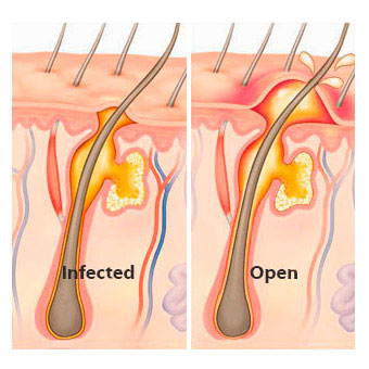 An illustration shows the progression of a boil infection.