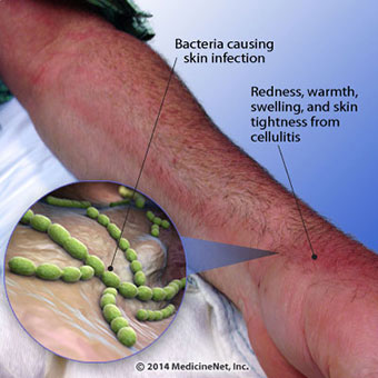 This illustration shows the signs and symptoms of cellulitis.