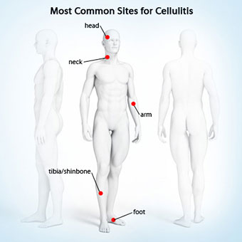 This illustration shows the most common sites for cellulitis.