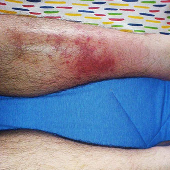 Cellulitis on the left leg of a male with microscopic images of normal skin over the right leg and deeper subcutaneous tissue involved in a case of cellulitis on the left leg.