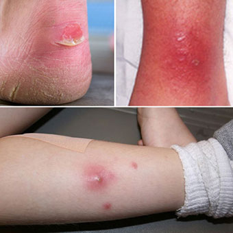 1. Close-up of an open wound on the back of a person's heel along with very dry cracked skin. 2. Patient with cellulitis on the ankle. 3. Abscess and associated cellulitis caused by community-acquired methicillin-resistant Staphylococcus aureus (CA-MRSA).