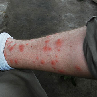 Itchy red welts from chigger bites on a man's leg.