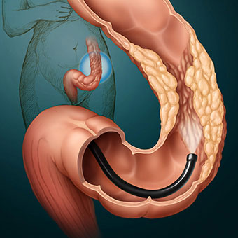 A medical illustration of a colonoscopy.
