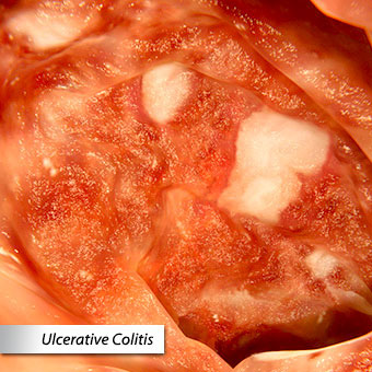An endoscopic view of ulcerative colitis.