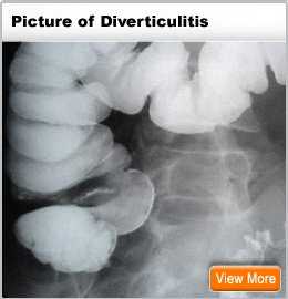 Picture of Diverticulitis