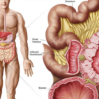 Illustration of diverticulosis in the colon.