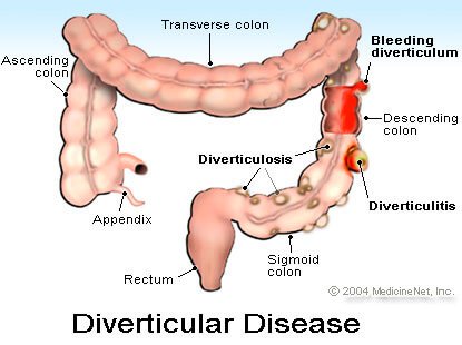 Picture of Diverticular Disease