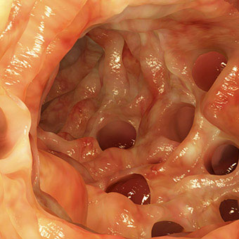Artwork based on an endoscopic image of diverticula in the colon.