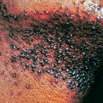 A man suffers from severe ingrown hairs on his neck.