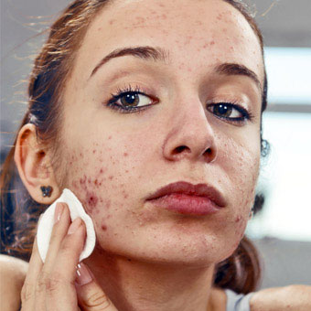 A girl has acne vulgaris.