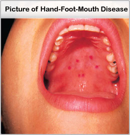 Picture of Hand-Foot-and-Mouth Disease