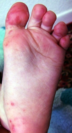 Picture of characteristic rash and blisters of hand, foot, and mouth disease