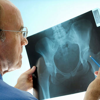 A doctor examines a hip X-ray.