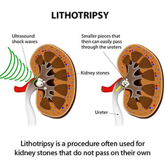 Lithotripsy is a procedure often used for kidney stones that do not pass on their own.