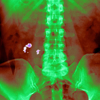 X-ray of kidney stones.