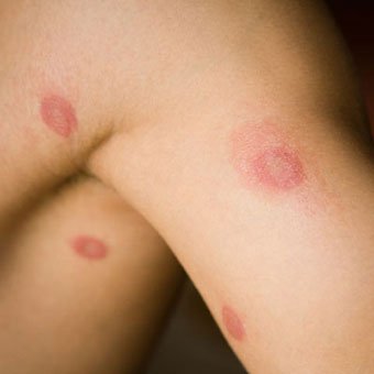 A person has ringworm on the body.