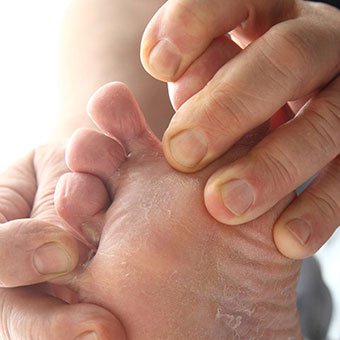 A person examines in between toes for skin fungi.