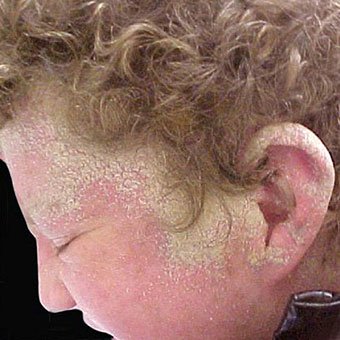 Crusted Norwegian scabies lesions can be seen on the ear of a patient.
