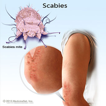 Illustration of scabies.