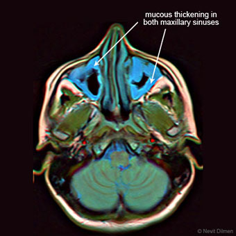 False color brain MRI showing mucosal thickening in both maxillary sinuses.