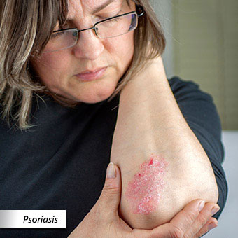 A woman examines a patch of psoriasis on her elbow.