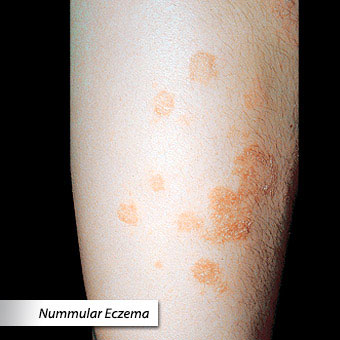 A close-up of a nummular eczema rash.