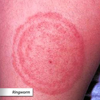 A close-up of a circular rash caused by ringworm.