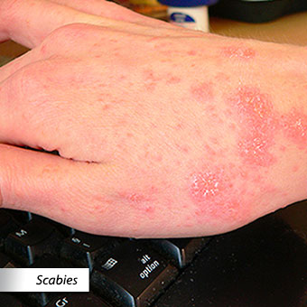 A picture of scabies.