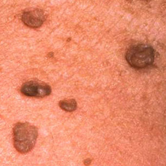 Purple and black skin tags may bleed as part of the healing process.