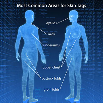 A 3-D illustration shows where skin tags can occur on the body.