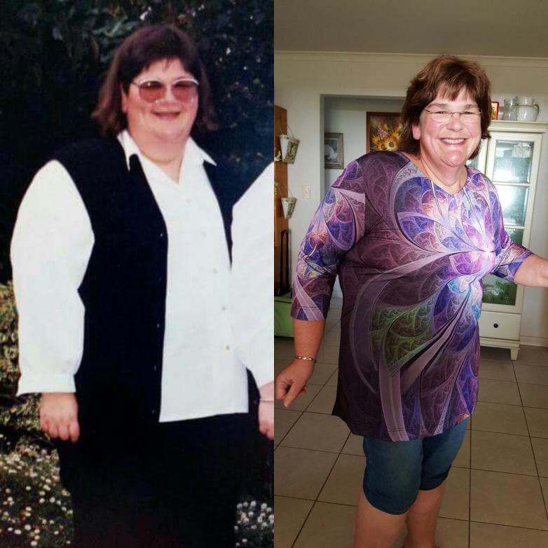 weight loss surgery transformation 
