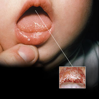 Close-up of oral thrush, showing ulcers inside the mouth of a baby