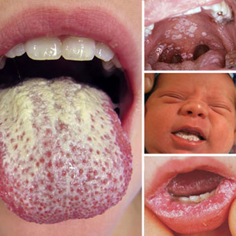 Examples of thrush (oral candidiasis)