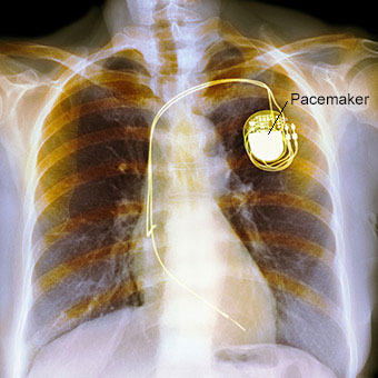 Colored X-ray of the chest of a patient with a dual chamber pacemaker.