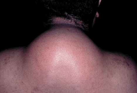 Picture of HIV Lipodystrophy 