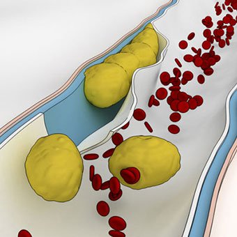 Picture of cholesterol plaque build-up on the inside of an artery.