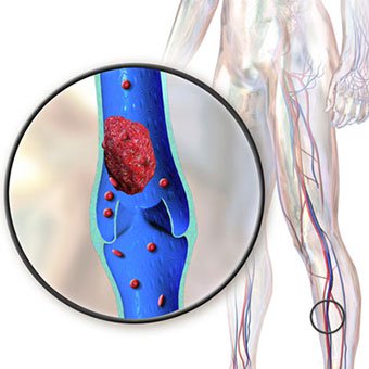 A picture of deep vein thrombosis.