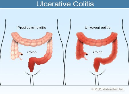 Ulcerative Colitis Illustration