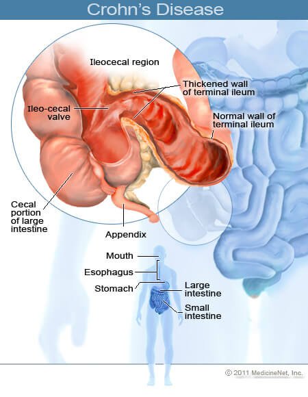 Picture of Crohn's Disease