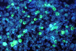 Light-colored cells are leukemia cells that contain EBV