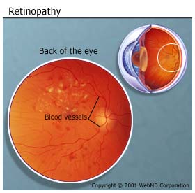 Picture of Diabetic Retinopathy of the Eye